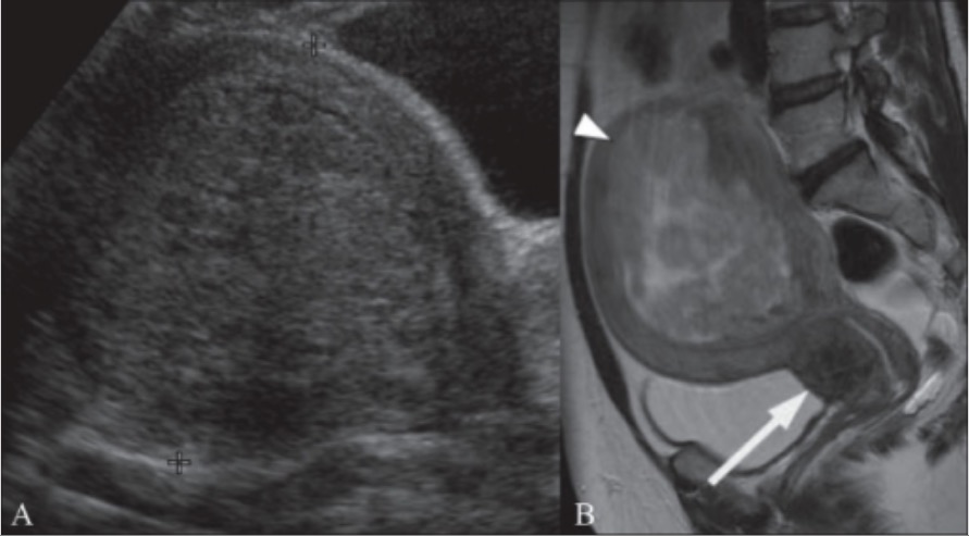 Radiology of uterine fibroids