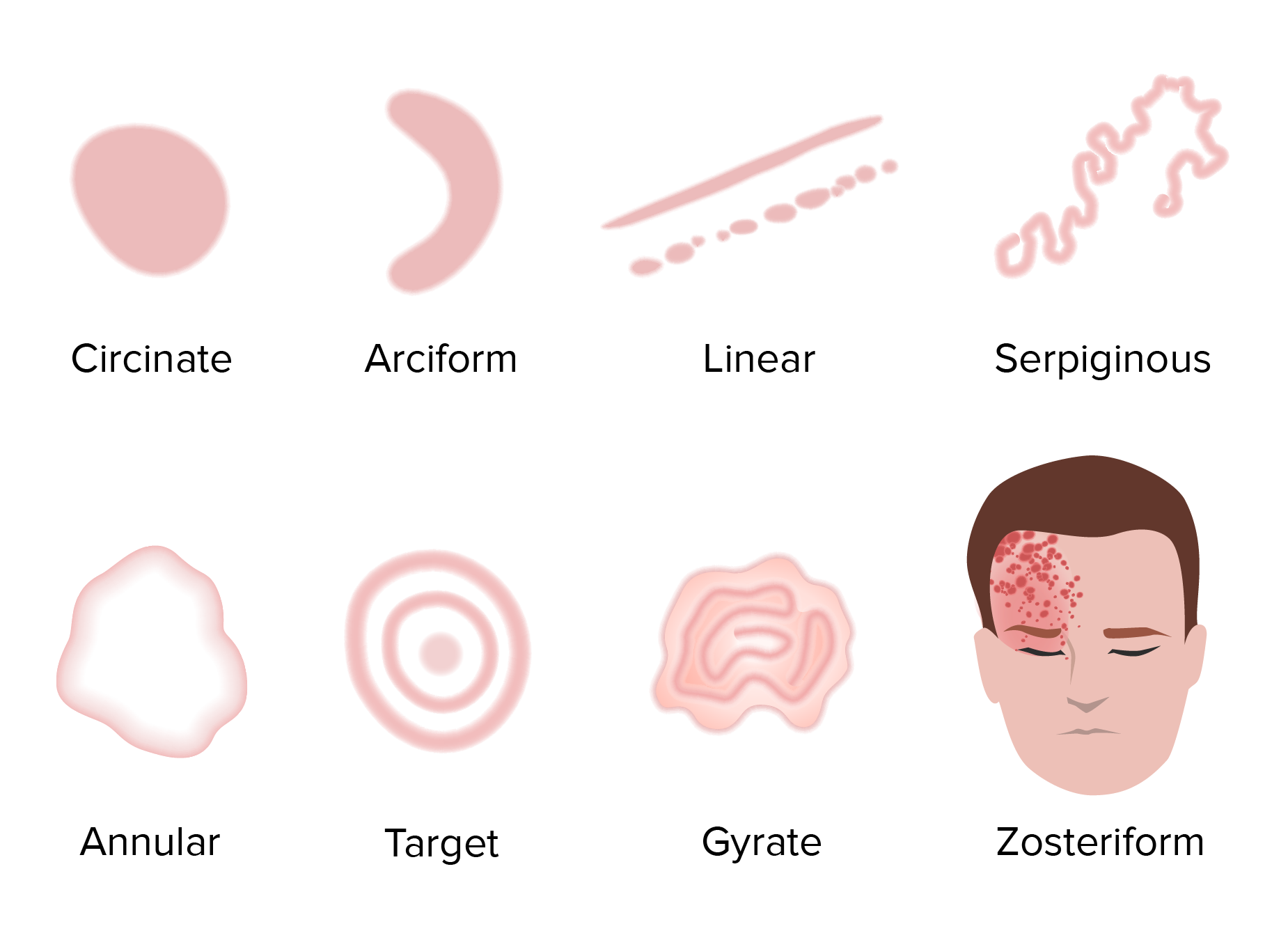 Figure. Maculopapular rash with diffuse petechiae, with areas of normal ...