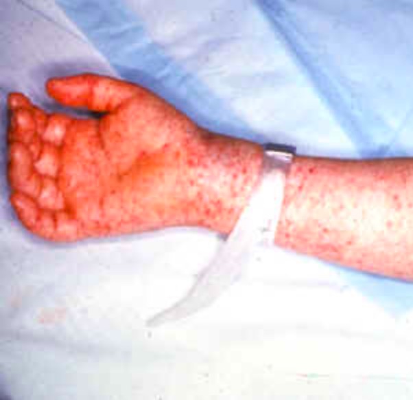 Rash in rocky mountain spotted fever