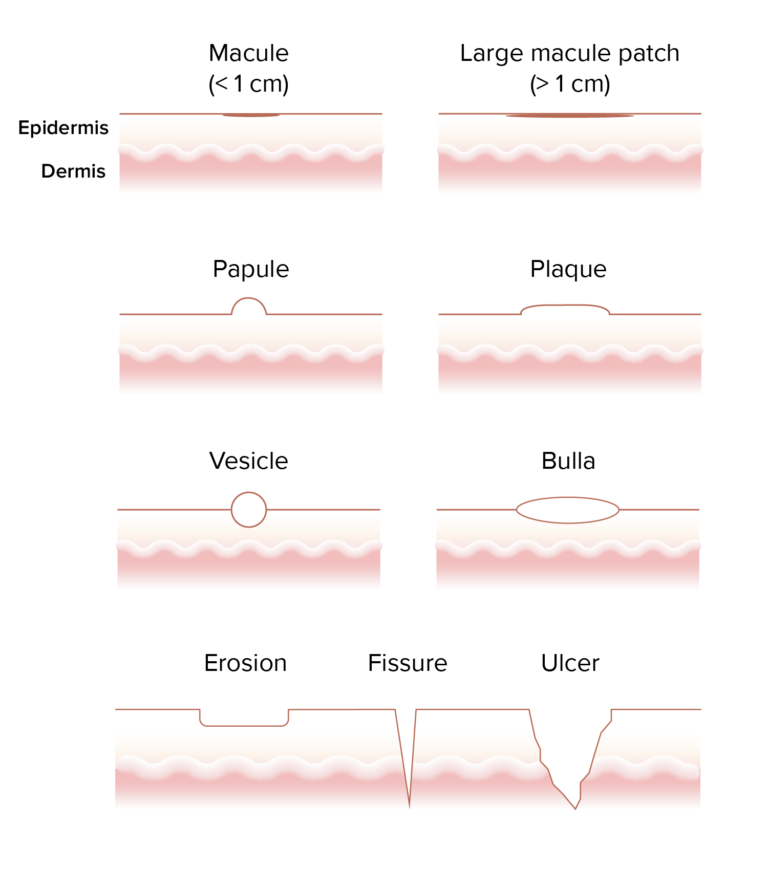 Circular Skin Rash Identification Chart