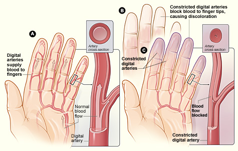 Fenómeno de Raynaud, Síndrome ou Doença de Raynaud