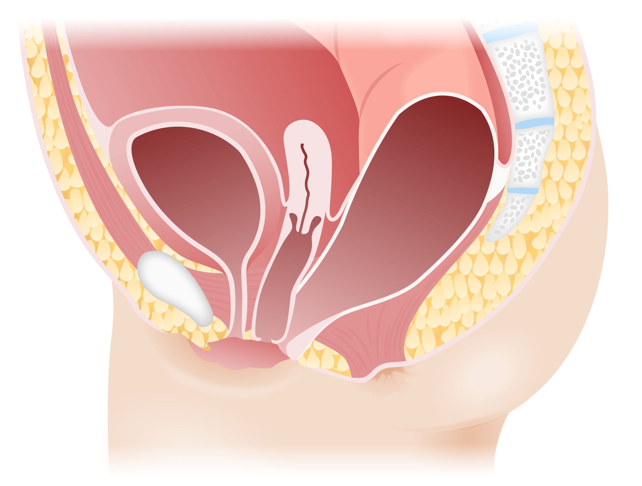 Rectovestibular fistula in females