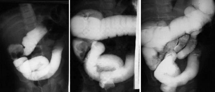 intussusception claw sign