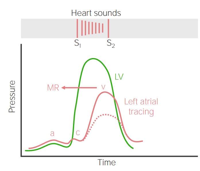 Mitral Regurgitation Concise Medical Knowledge