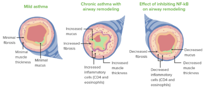 Remodelling and pathological changes noted in asthma