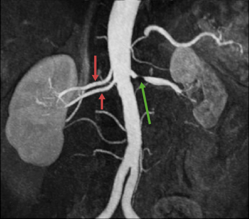 Renal artery stenosis