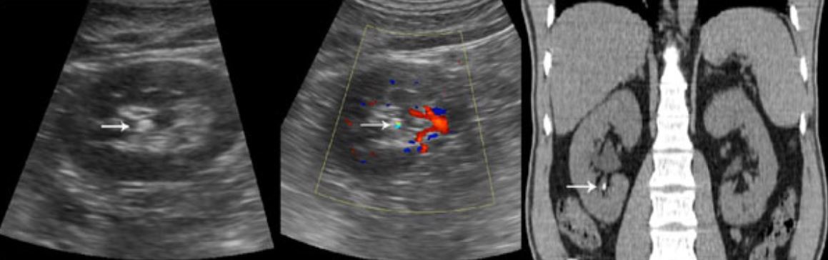 Renal calculus on ultrasound and ct
