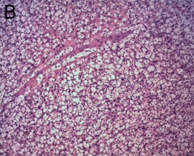 Carcinoma renal de células claras com células sólidas transparentes semelhantes a folhas
