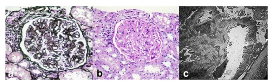 Renal histopathologic findings in a patient with systemic lupus erythematosus