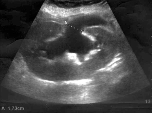 Renal ultrasound demonstrating severe hydronephrosis