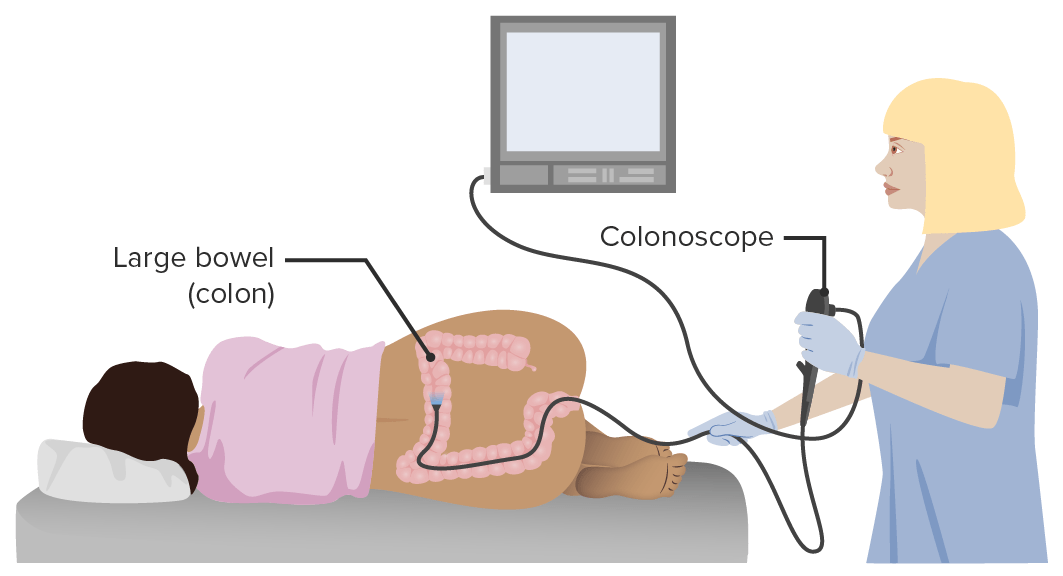 Representation of colonoscopy