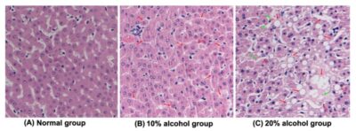 Alcoholic Liver Disease 