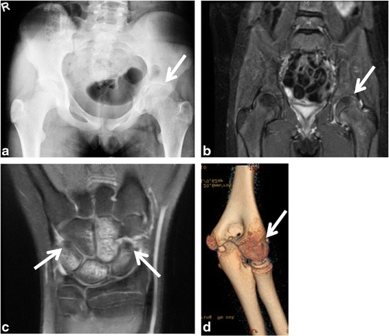 Representative images of severe monoarthritis in children diagnosed with oligoarticular juvenile idiopathic arthritis