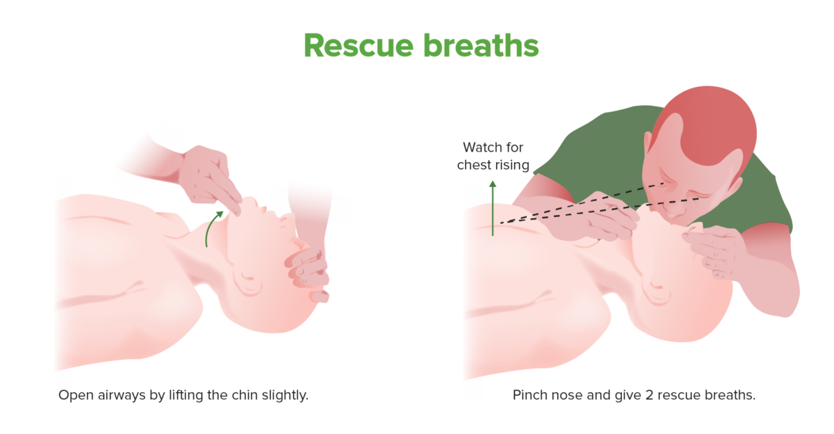 Rescue breath technique