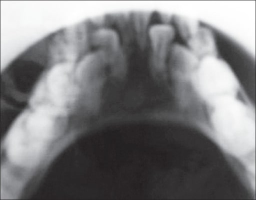 Retention of primary dentition x-ray