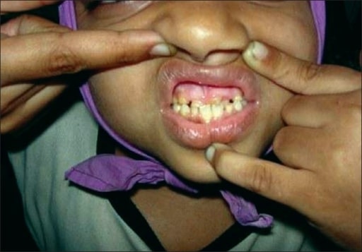 Retention of primary dentition