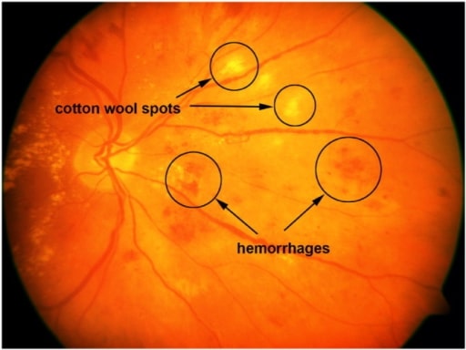 retinopatía hipertensiva vs normal