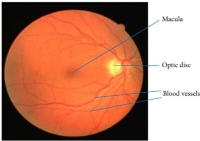 Macular Degeneration | Concise Medical Knowledge