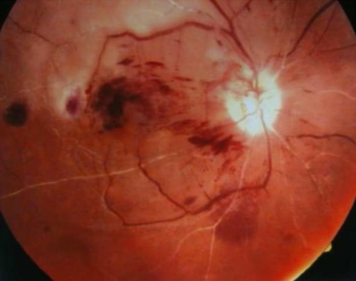Retinal vessel occlusion