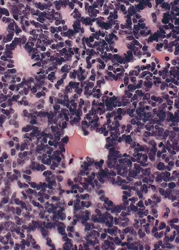 Retinoblastoma rosette