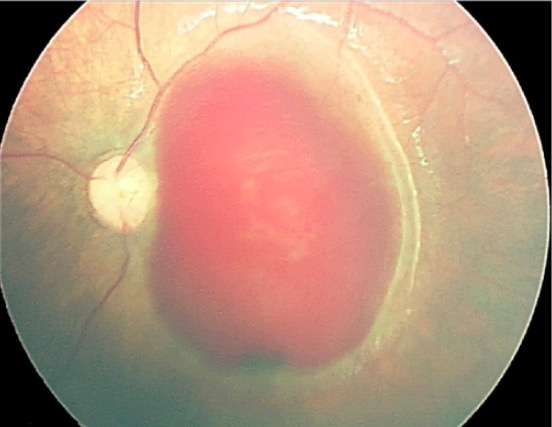 Diagnóstico por retinografia na síndrome da criança abanada