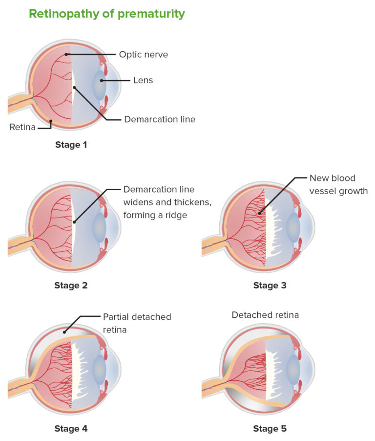 Retinopathy Of Prematurity Concise Medical Knowledge