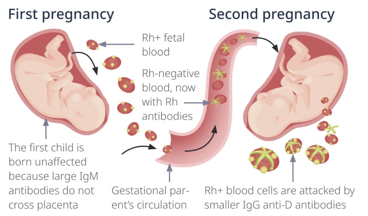 Rh incompatibility in several pregnancies
