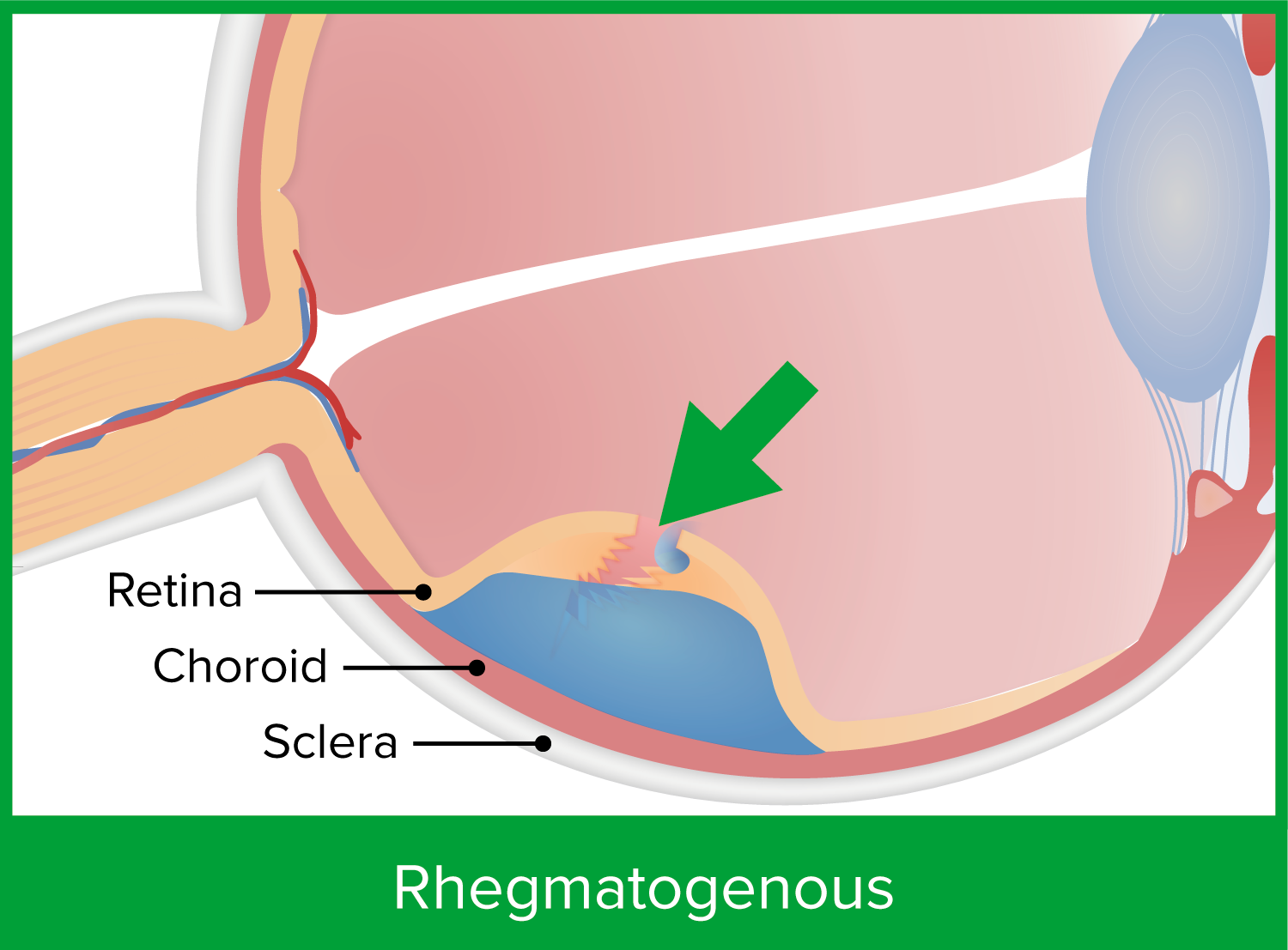 Rhegmatogenous Retinal Detachment Oct