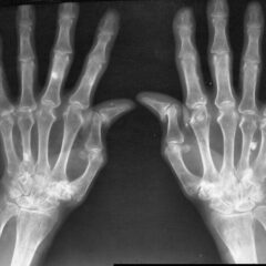 Rheumatoid arthritis X-ray