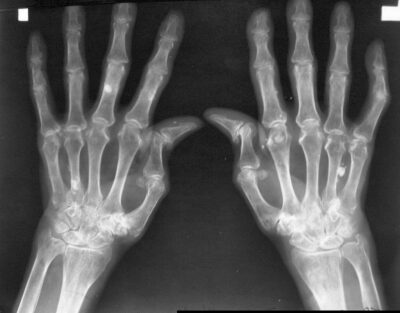Rheumatoid Arthritis | Concise Medical Knowledge