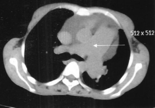 Rheumatoid interstitial lung disease cor pulmonale