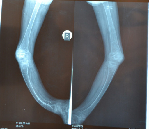 X-ray rickets