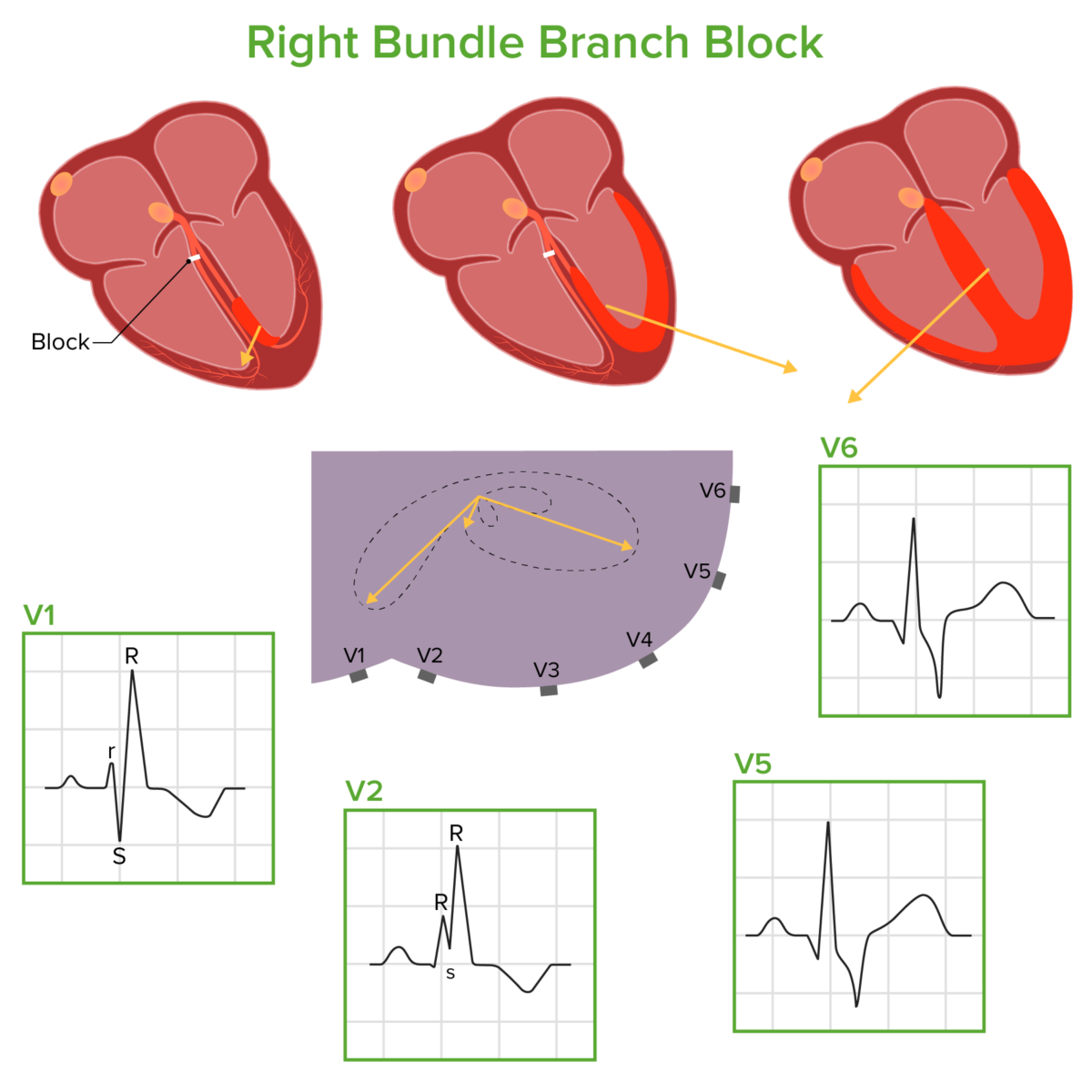 Right bundle branch block pathophysiology