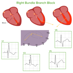 Bundle Branch and Fascicular Blocks | Concise Medical Knowledge