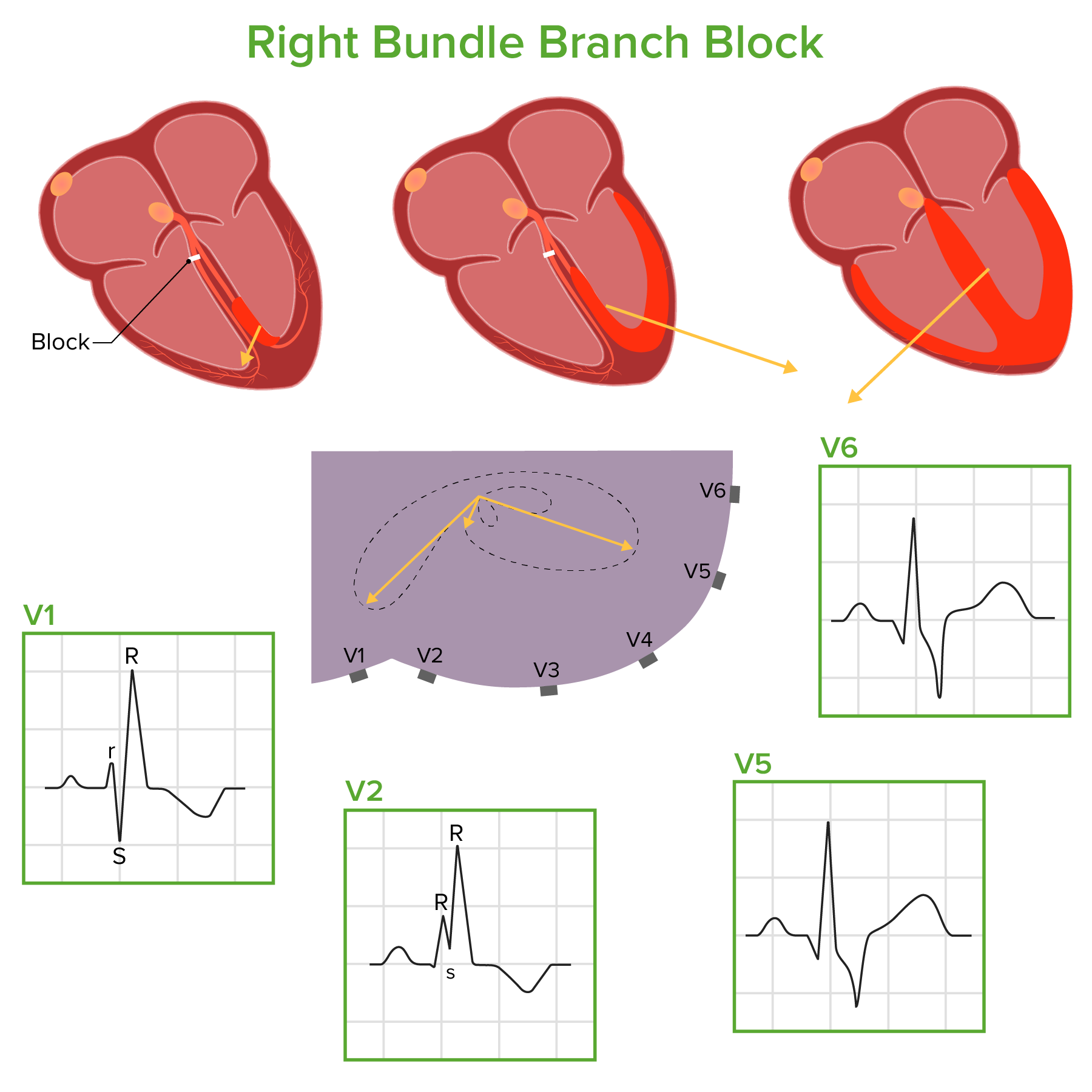 Bundle Branch Block Measurement