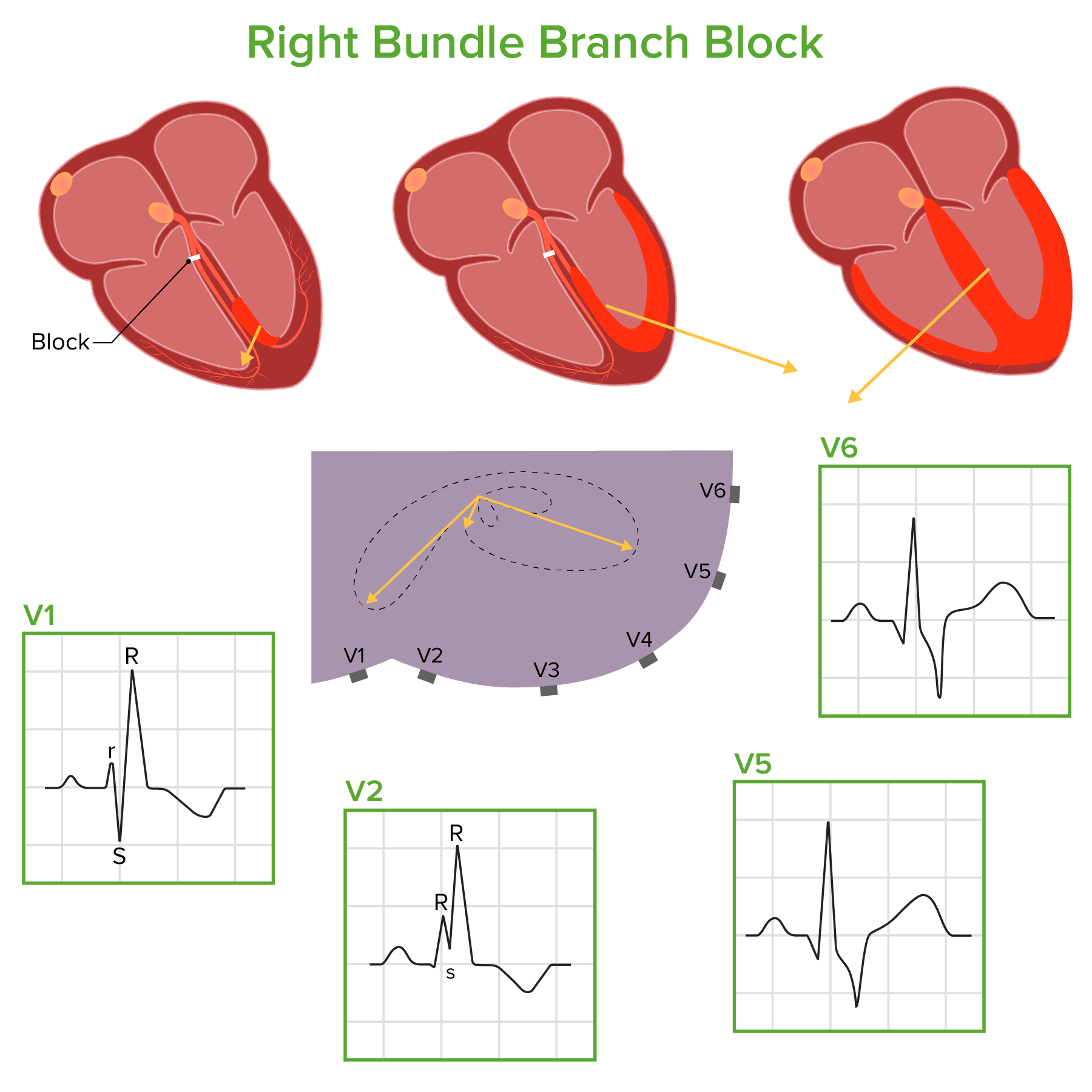 his of bundle branch of left