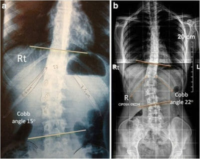 Escoliosis | Concise Medical Knowledge