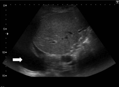 Pleural Effusion | Concise Medical Knowledge