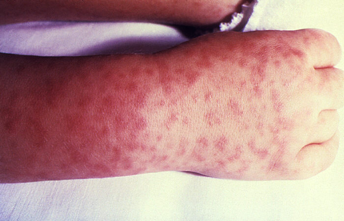 Characteristic spotted rash of rocky mountain spotted fever