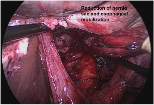 Sac excision hernia repair