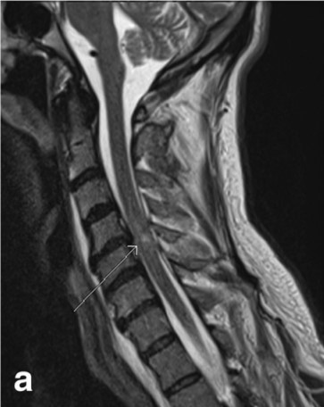 Sagittal mri of a patient after acute spinal contusion