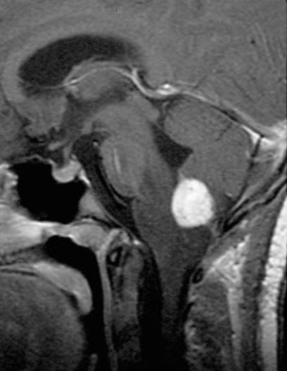 Sagittal, contrasted, t1-weighted mri shows contrast enhancing medullary hemangioblastoma