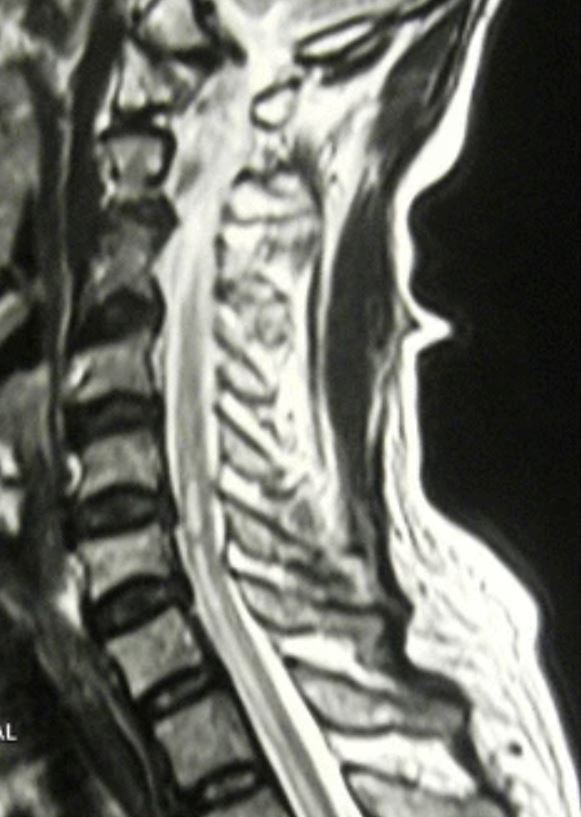 Vista sagital de resonancia magnética en t2 de la columna vertebral que muestra cambios isquémicos "en forma de lápiz" en la médula espinal, consistentes con el síndrome medular anterior