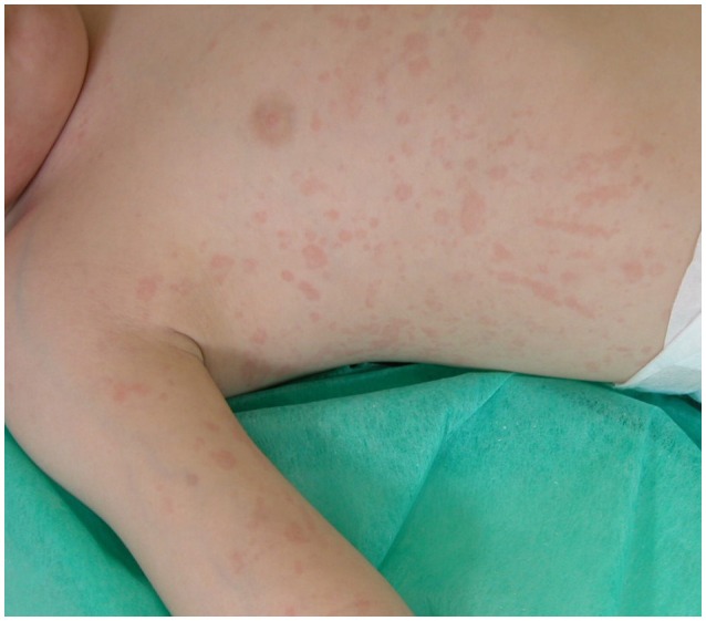 Salmon-macular rash in systemic juvenile idiopathic arthritis