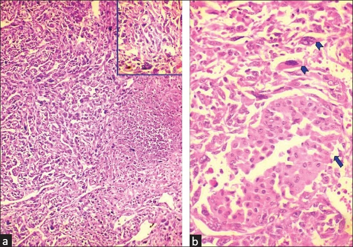 Carcinoma de células renais cromofobo sarcomatóide