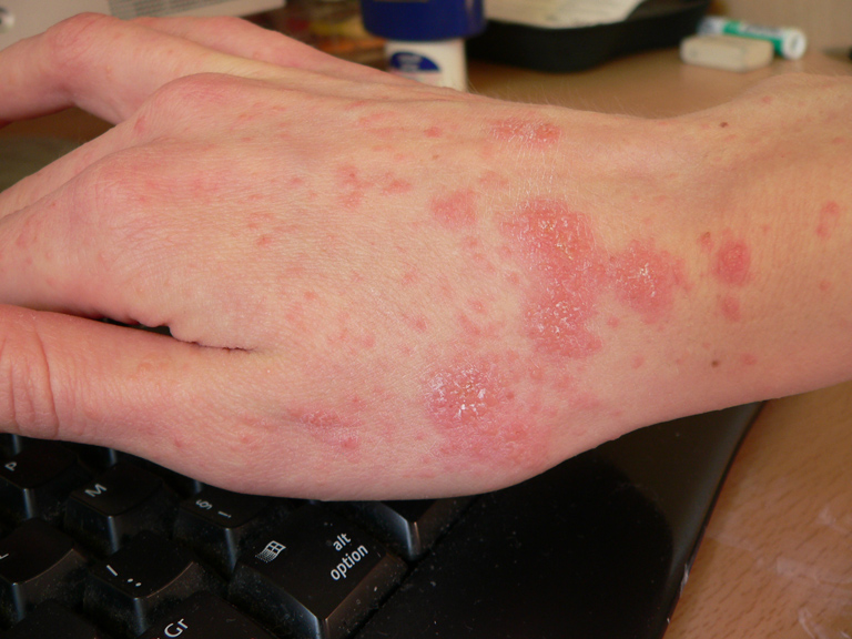 Scabies on right hand