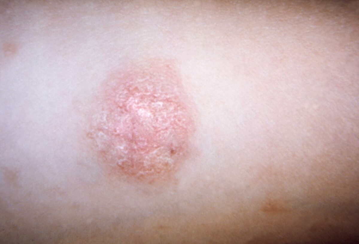 Scale on a herald patch of pityriasis rosea