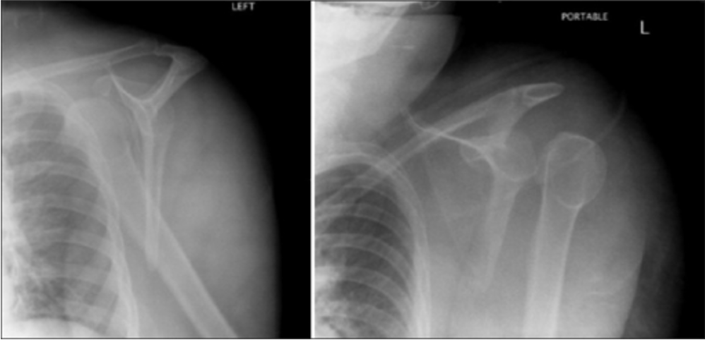 Scapular y views of anterior and posterior dislocation of the left shoulder