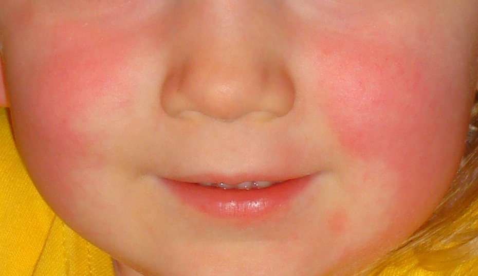 Scarlet Fever  Concise Medical Knowledge