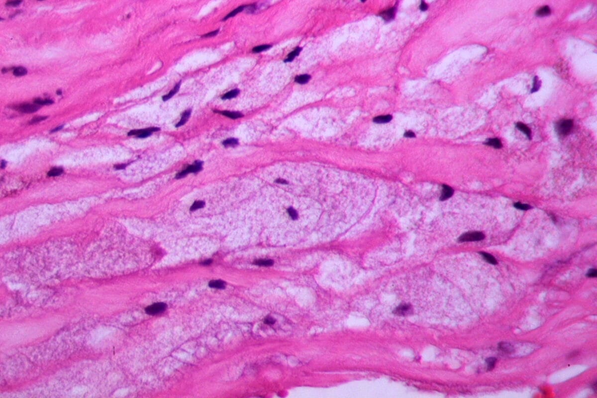 Schaumzellen in einem atherosklerotischen plaque
